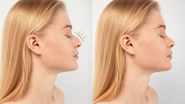 5 Cara Memancungkan Hidung Secara Alami Tanpa Operasi, Dijamin Aman!