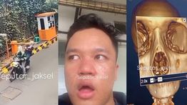 Penumpang Ojol Kena Palang Parkir hingga Tulang Hidung Retak