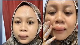 Viral Wanita Ini Alami Bibir Bengkak Jelang Ijab Kabul, Namun Tetap Santai