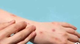 Santri di Meranti Diduga Terinfeksi Cacar Monyet Meninggal