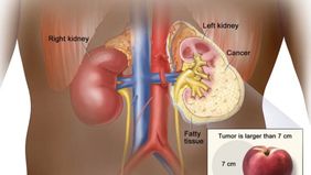 Dokter spesialis penyakit dalam konsultan hematologi dan onkologi dari Rumah Sakit Cipto Mangunkusumo, Andhika Rachman, menyampaikan bahwa menjaga kesehatan ginjal selama bulan puasa dapat dilakukan dengan langkah sederhana.