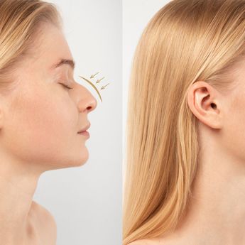 5 Cara Memancungkan Hidung Secara Alami Tanpa Operasi, Dijamin Aman!