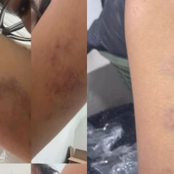 Kronologi Influencer Cianjur Jadi Korban Penganiayaan Mantan Pacar