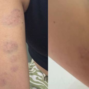 Keji! Influencer Cianjur Jadi Korban Penganiayaan Mantan Pacar