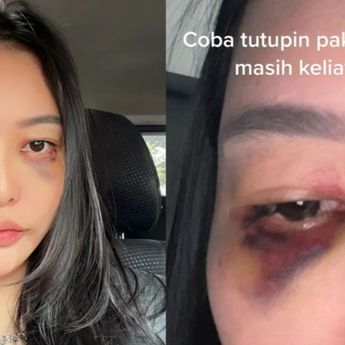 Bidi Jadi Korban KDRT Suami Usai Bongkar Perselingkuhan dengan LC