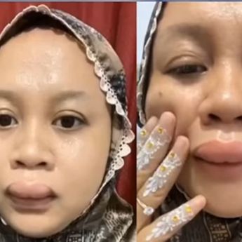 Viral Wanita Ini Alami Bibir Bengkak Jelang Ijab Kabul, Namun Tetap Santai