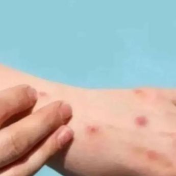 Santri di Meranti Diduga Terinfeksi Cacar Monyet ahirnya Meninggal