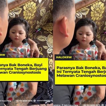 Heboh Beredar Video Bayi Cantik Didiagnosis Derita Craniosynostosis