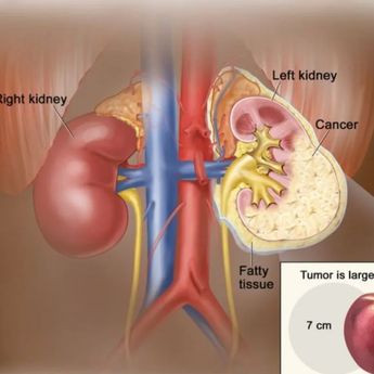 Dokter RSCM Ingatkan Pentingnya Cukup Minum Air Saat Puasa Untuk Jaga Ginjal