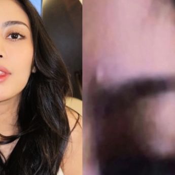 Rachel Vennya Diduga Kena Jotos Okin hingga Kelopak Mata Lebam