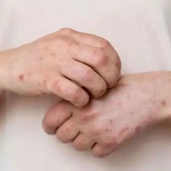 Wabah Campak di Bangladesh Tewaskan 294 Anak, Tembus 45 Ribu Kasus