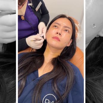 Nita Gunawan Akui Menyesal Jalani Oplas dan Filler Karena Rasa Insecure