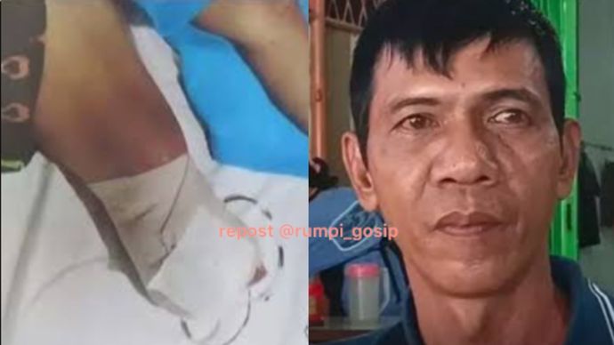 Kaki Pasien Malpraktik di Medan Diamputasi Tanpa Izin