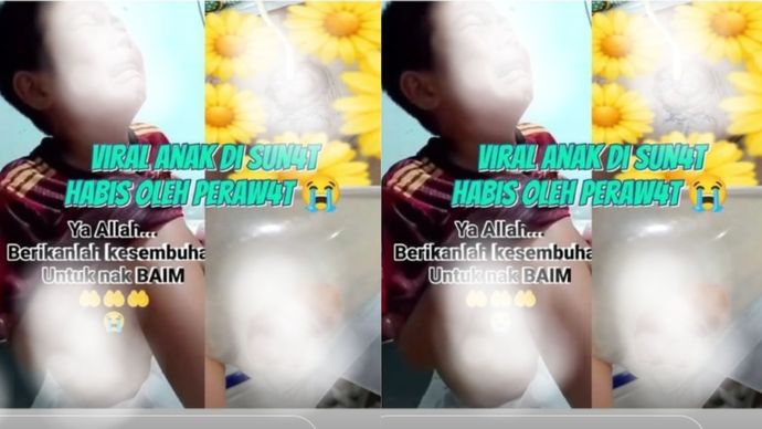bocah laki-laki berusia 10 tahun berinisial BAI menjadi korban dugaan malpraktik saat menjalani prosedur khitan dengan metode laser.