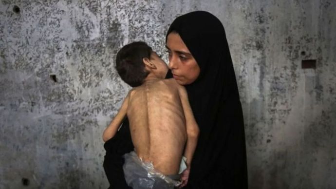Arsip foto - Seorang anak Palestina yang menderita kurang gizi dan cerebral palsy digendong ibunya di tempat pengungsian di Gaza, Palestina, 25 Juli 2025. 