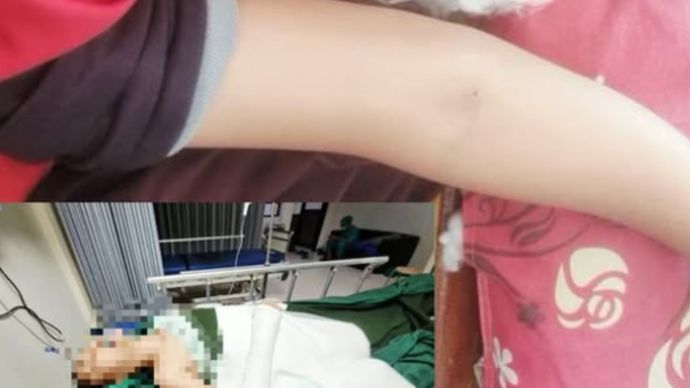 Kasus perundungan kembali mengguncang dunia pendidikan di Karawang. Seorang siswi kelas 6 salah satu SD negeri di Kecamatan Tirtajaya berinisial NER menjadi korban kekerasan beruntun yang dilakukan oleh teman sekolahnya sendiri, hingga menyebabkan patah tulang tangan dan trauma mendalam.