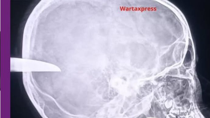 Sebuah foto hasil pemeriksaan radiologi (rontgen) yang memperlihatkan benda menyerupai senjata tajam tertancap di bagian belakang kepala korban tawuran di Cikupa, Kabupaten Tangerang.