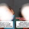 Bocah 4 Tahun di Sukabumi Tewas Setelah Tubuhnya Dipenuhi Cacing