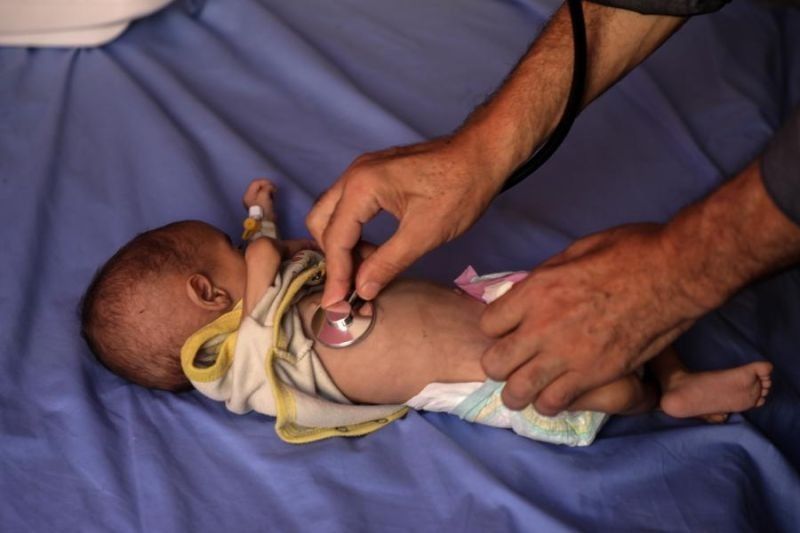Seorang balita Palestina yang menderita malnutrisi karena kelaparan dirawat di Rumah Sakit Al-Rantisi di Kota Gaza, 23 Juli 2025. (Xinhua/Rizek Abdeljawad) <b>(Antara)</b>