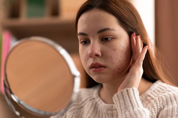 5 Cara Menghilangkan Bekas Jerawat dengan Bahan Alami - Halaman 2