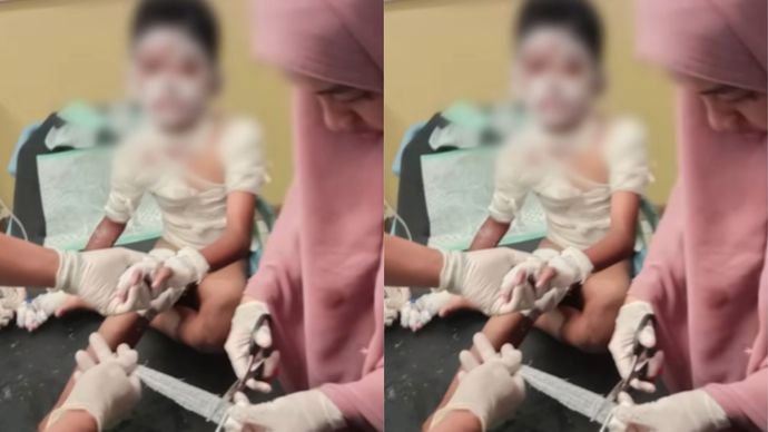 Kronologi Bocah SD 10 Tahun di Situbondo Dibakar Temannya Sendiri