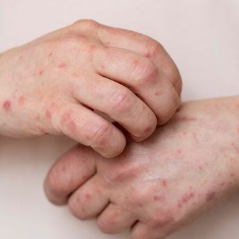 Menkes Jelaskan Pola Penularan Mpox, Mirip dengan HIV-AIDS