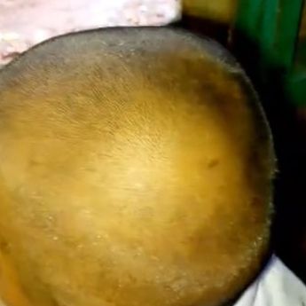 Ngeri, Penduduk Desa Ini Alami Insiden Kerontokan Rambut Massal Misterius